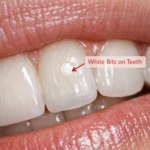 white bits on teeth