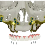 subperiosteal implant