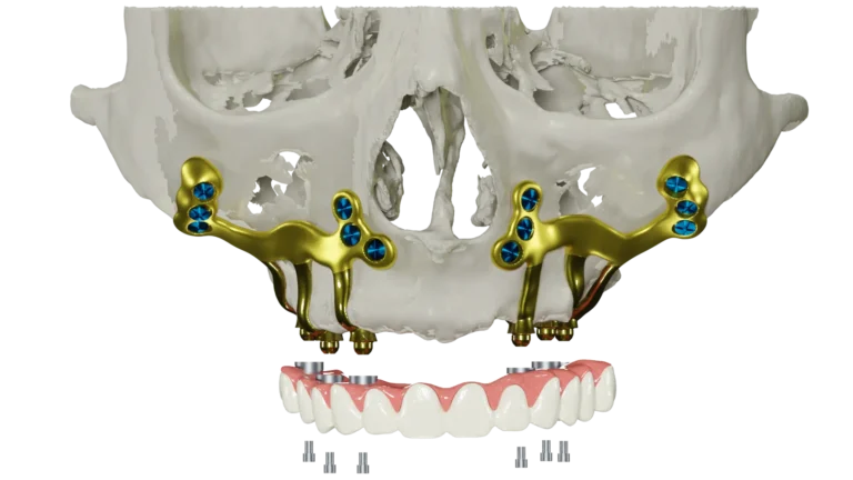 subperiosteal implant